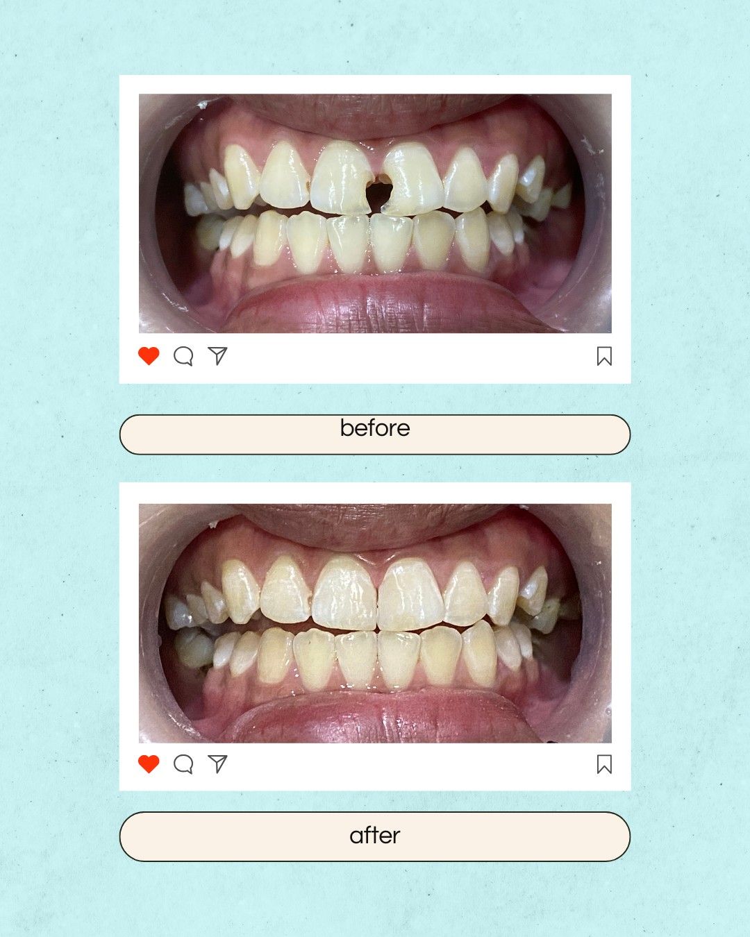 Composite (White) Fillings