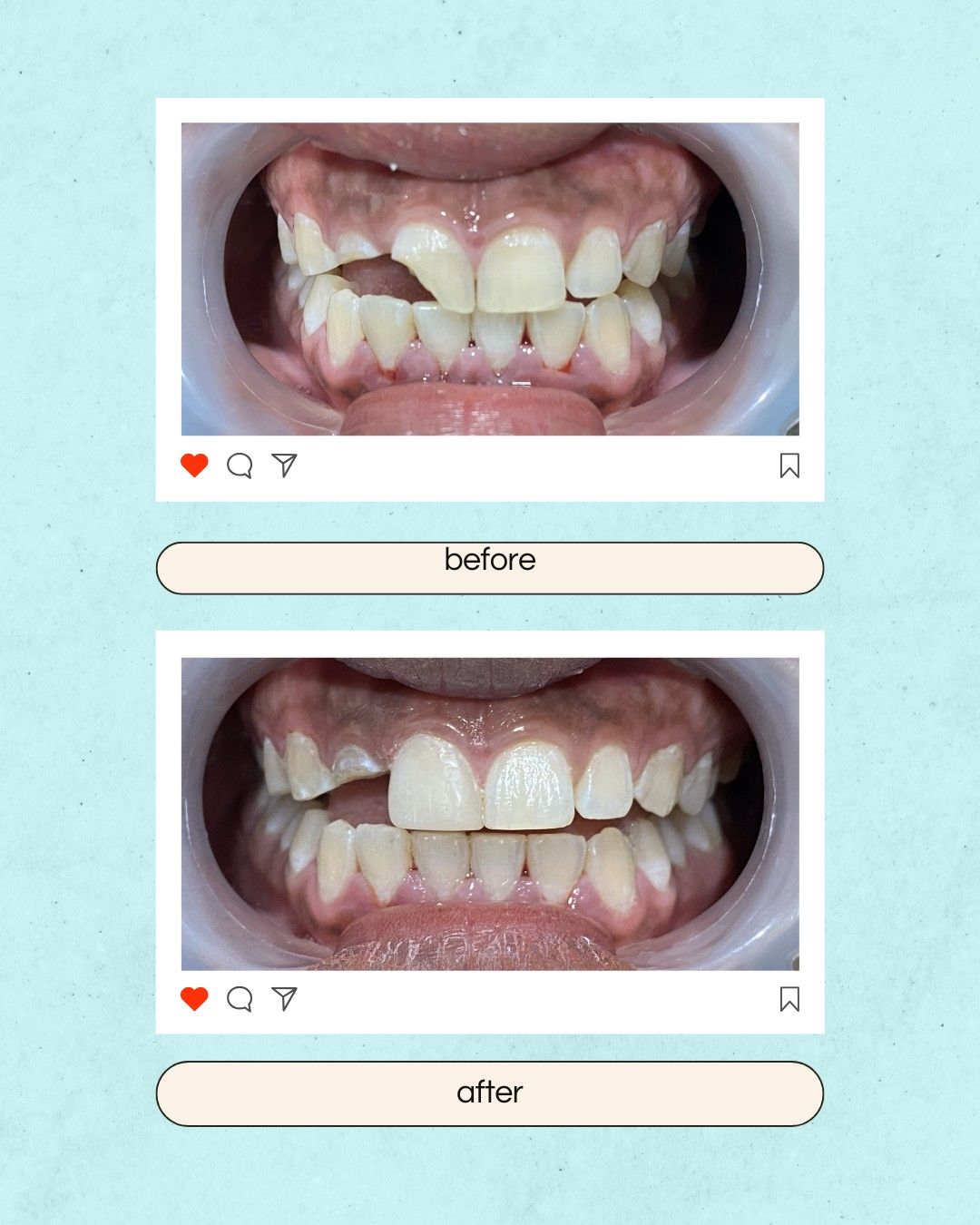 Composite (White) Fillings